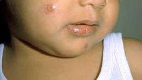 الكوليرا يزحف نحو أدرار في رمضان