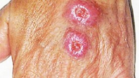 إصابة  57  شخصا  بالليشمانيا  الجلدية  في  الوادي