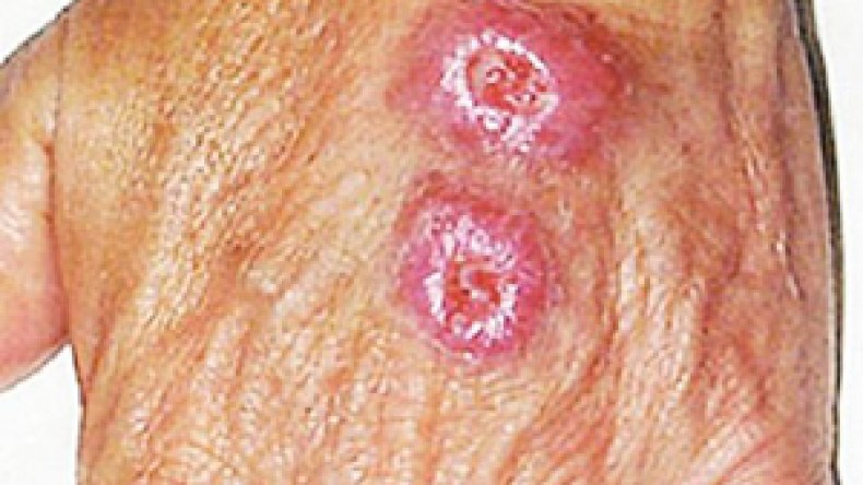 إصابة  57  شخصا  بالليشمانيا  الجلدية  في  الوادي