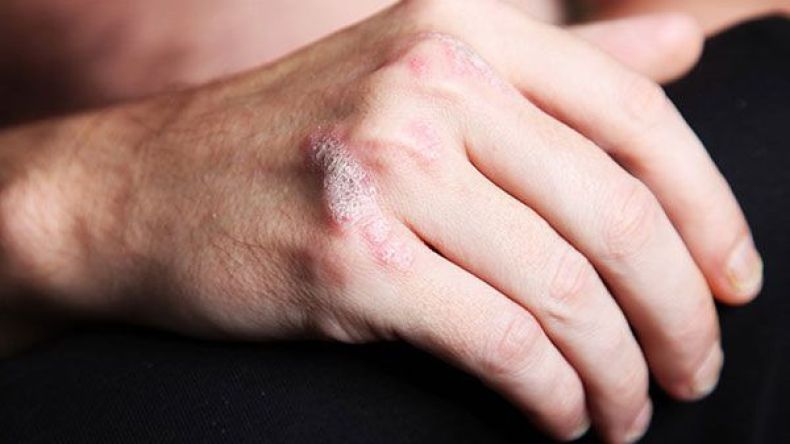 إحياء اليوم العالمي لمرض الصدفية في العاصمة