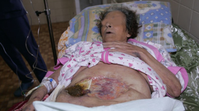 مريضة ترقد ببطن مفتوح وأمعاء متدلية في مستشفى القبة