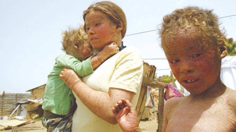 أمير إماراتي تكفل بأفراد العائلة الذين يكسوهم جلد الثعابين