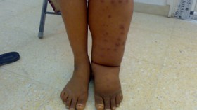 مرض الفيله النادر يفتك بفتاة جامعية بورقلة