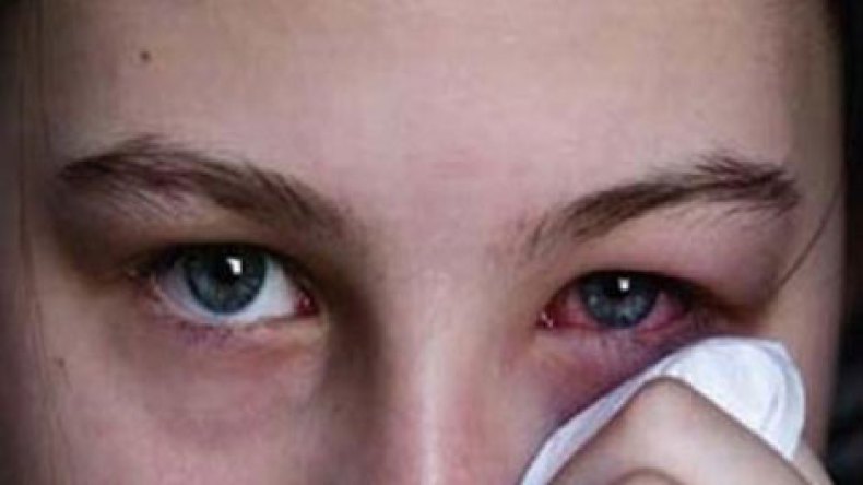 الرمد الحبيبي يهدد 1400 تلميذ بالعمى في الجنوب