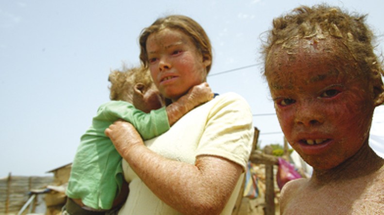 مأساة عائلة يكسوها جلد الثعابين تعيش الجحيم تحت القصدير