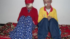 مرض غريب يأكل جسدي شقيقين أمام أنظار المسؤولين!