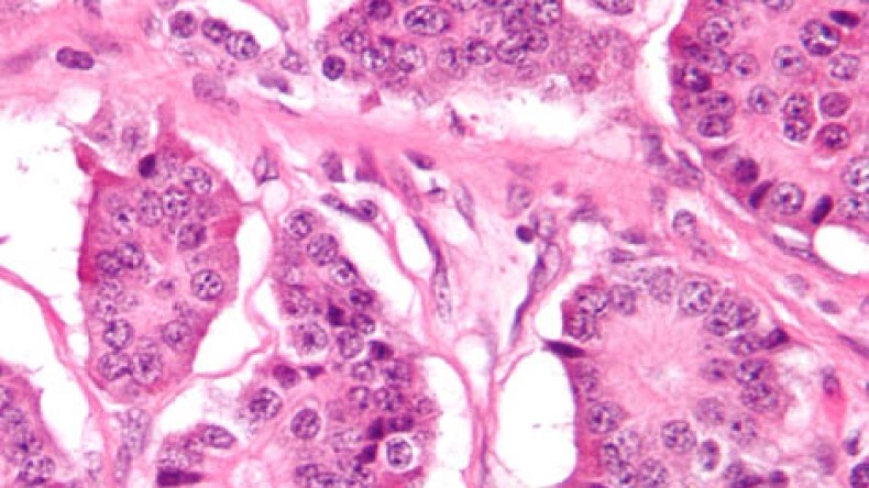 تضاعفت 5 مرات خلال 30 سنة: أورام الغدد العصبية.. الثانية في الجزائر بعد سرطان الرئة