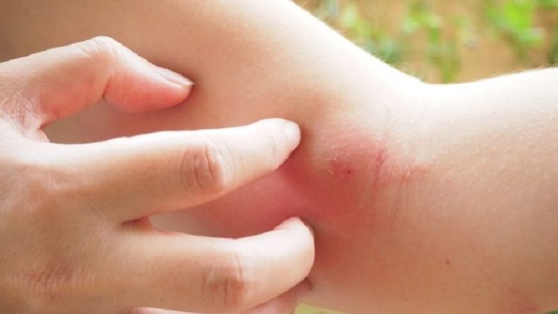 إصابة 80 شخصا بلسعات مجهولة المصدر بقالمة