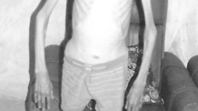 مخلوف امتصه المرض فحوله إلى هيكل عظمي بوزن الأطفال