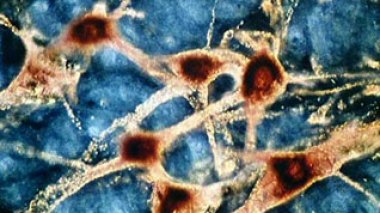 Parkinson: des cellules immunitaires deviennent des tueuses de neurones