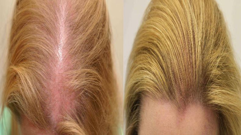 هاجس الصلع عند النساء.. ينفقن الملايين والشعر لا يعود