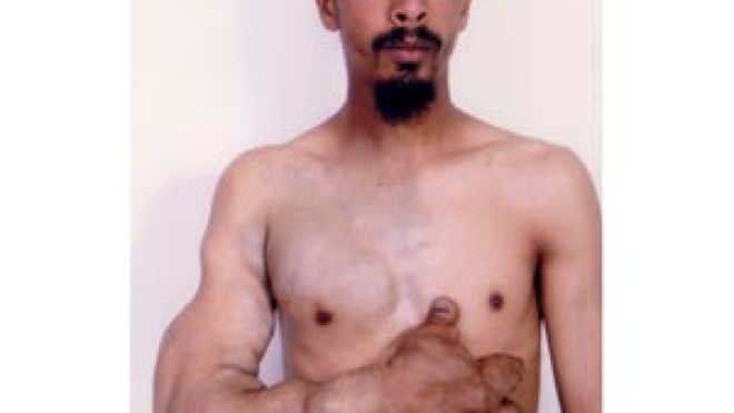 فتحي يعاني ورما نادرا وعاجز عن توفير تكاليف فحوصات أشعة الليزر