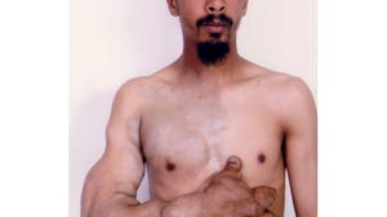 فتحي يعاني ورما نادرا وعاجز عن توفير تكاليف فحوصات أشعة الليزر