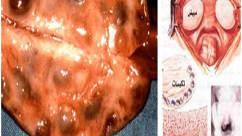 احمي نفسك من تكيّس المبايض..