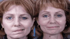 شلل بيل.. الأعراض والعلاج