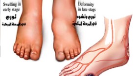 “مرضى القدم السكرية يعانون بالمستشفيات وبحاجة لمصلحة خاصة”