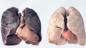 الجزائر تحتل المرتبة الأولى عالميا في الإصابة بسرطان الرئة