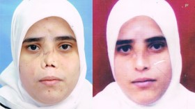 خطأ طبي‮ ‬شوّه وجه”ربيعة‮” ‬وحرمها من العمل‮!‬