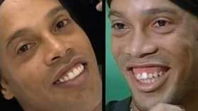 رونالدينيو ينفق أزيد عن نصف مليار بسبب تشوّه خلقي