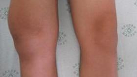 350 ‭ ‬ألف جزائري‭ ‬مصاب‭ ‬بالتهاب‭ ‬المفاصل‭ ‬الروماتيزمي‭ ‬