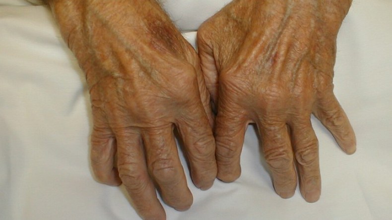 31 ألف إصابة بالروماتيزم في الجزائر سنويا