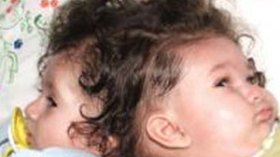 بعد‭ ‬‮”‬الصحة‮”‬‭ ‬وزارة‭ ‬العمل‭ ‬تتماطل‭ ‬في‭ ‬تحويل‭ ‬التوأم‭ ‬السيامي‭ ‬للعلاج‭ ‬بالخارج