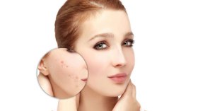 كيف أتخلص من حب الشباب؟