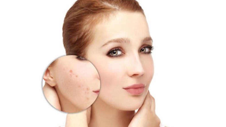 كيف أتخلص من حب الشباب؟