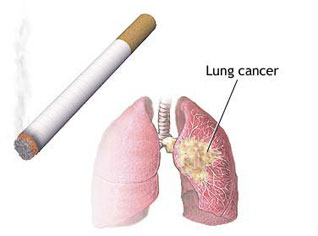 Smoking to kill 520 million smokers by 2050, Doctors warn