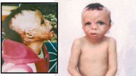 تلميذة مشوهة تحقق المستحيل وتتفوق على زملائها في الدراسة