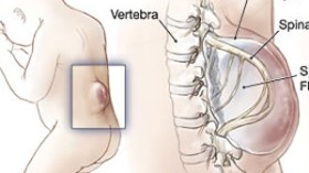 من يفرّج كربة «دعاء» ويخلصها من معاناتها مع “سبينابفيدا”
