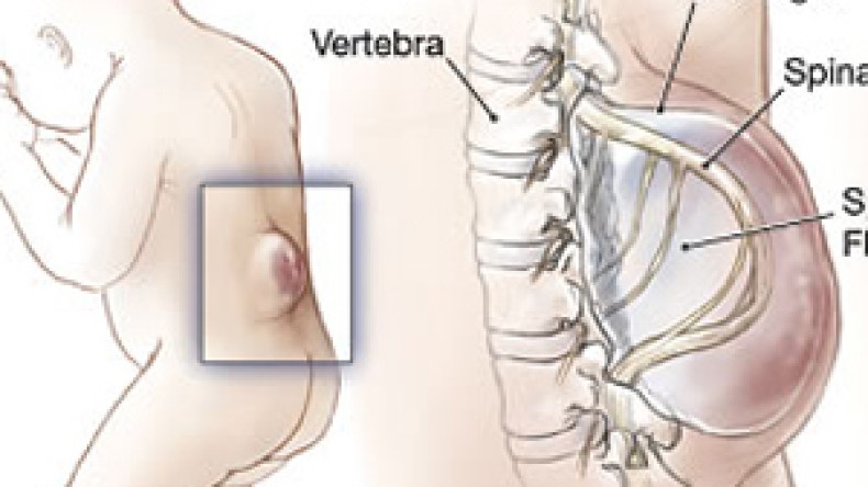 من يفرّج كربة «دعاء» ويخلصها من معاناتها مع “سبينابفيدا”