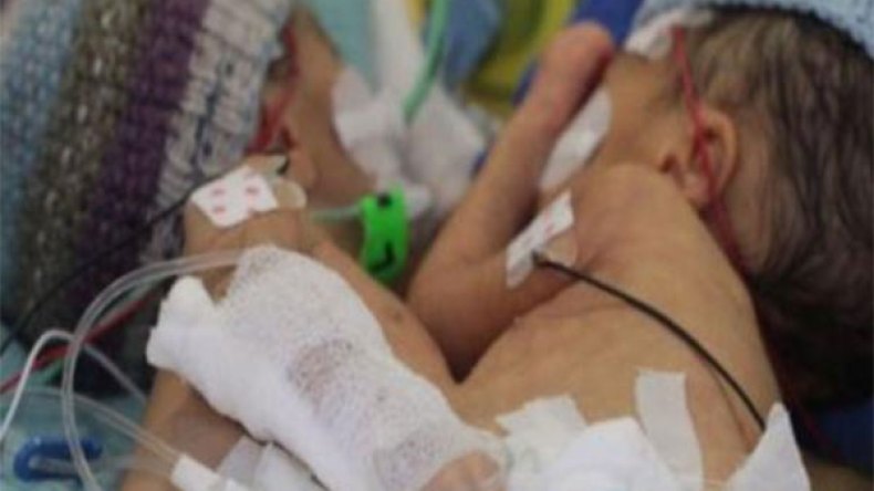 عائلة التوأم الملتصق بأم البواقي تستغيث وتطالب بإنقاذ حياة الطفلتين