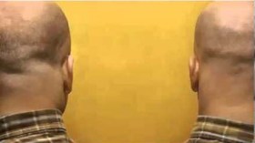 بلجيكا تسمح لتوأم بالانتحار في نفس اللحظة