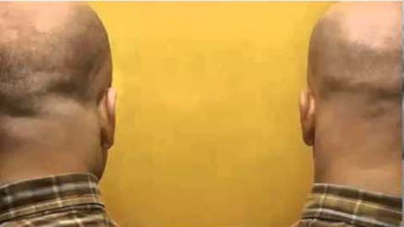 بلجيكا تسمح لتوأم بالانتحار في نفس اللحظة