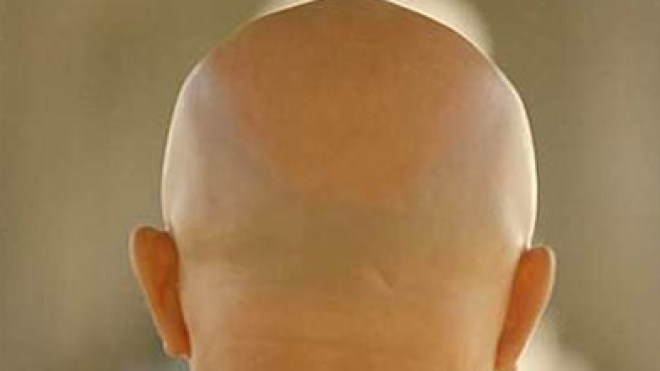 مواطنون أصيبوا بالصلع والأمراض الجلدية بسبب غسول شعر مهرب من تونس