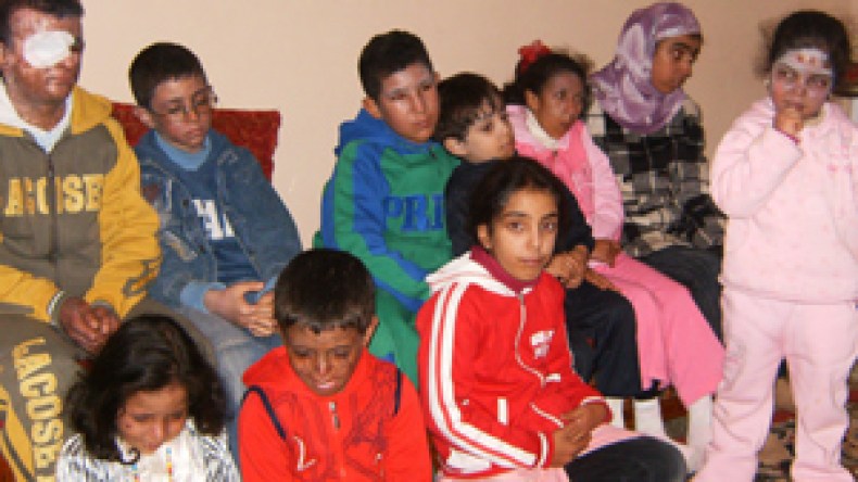 مرض خبيث يشوه وجوه المرضى ويقتلع أعينهم