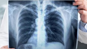 20 ألف مصاب بالسل.. وكورونا عدوهم الأول