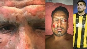 لاعب أرجنتيني كاد يفقد بصره بِسبب الألعاب النارية