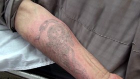 عشرات الجزائريين يزيلون الوشم بالليزر يوميا هروبا من الإحراج واحتراما للدين