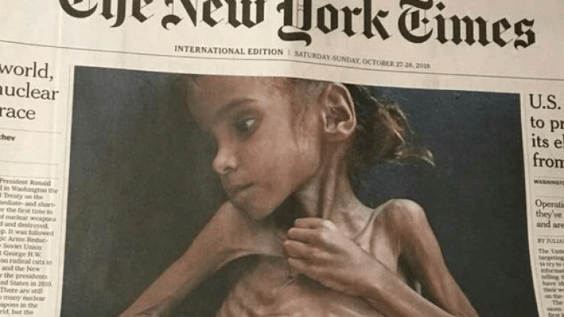 وفاة الطفلة أمل حسين التي حولت أنظار العالم إلى مجاعة اليمن