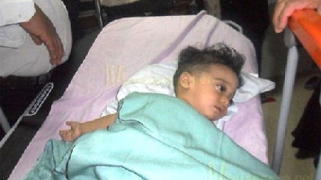 استخراج جنين في الشهر الثالث من بطن طفل يمني عمره 7 شهور