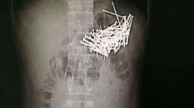 شاب يبتلع 87 مسمارا.. والسبب؟!