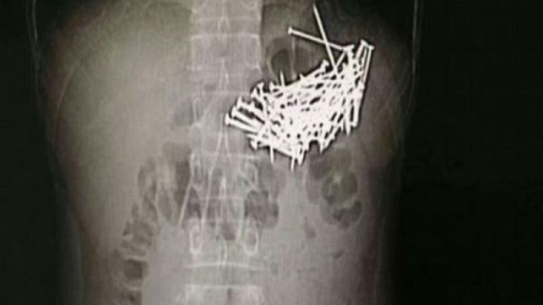 شاب يبتلع 87 مسمارا.. والسبب؟!