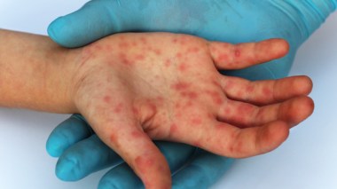 Rougeole: Neuf décès et plus de 6 000 cas