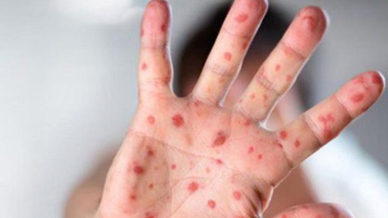 “البوحمرون” يعود بقوة والعائلات تتجنب المستشفيات خوفا من العدوى