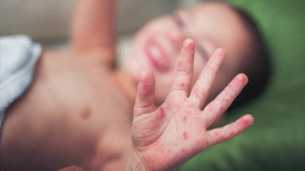 Sidi Belabess: 56 cas de rougeole suspectés