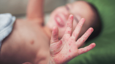 Sidi Belabess: 56 cas de rougeole suspectés