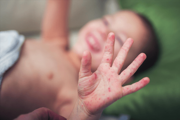 Sidi Belabess: 56 cas de rougeole suspectés