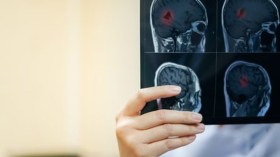 مرضى التصلب اللويحي يستفيدون لأول مرة من دواء فموي بدل الحقن